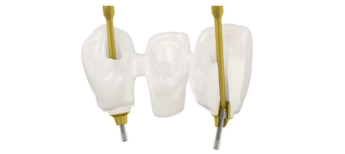 Individual-abutments-Aurum-base-up-to-25-inclination-milling_1/dess_pont_aurum_slide-212