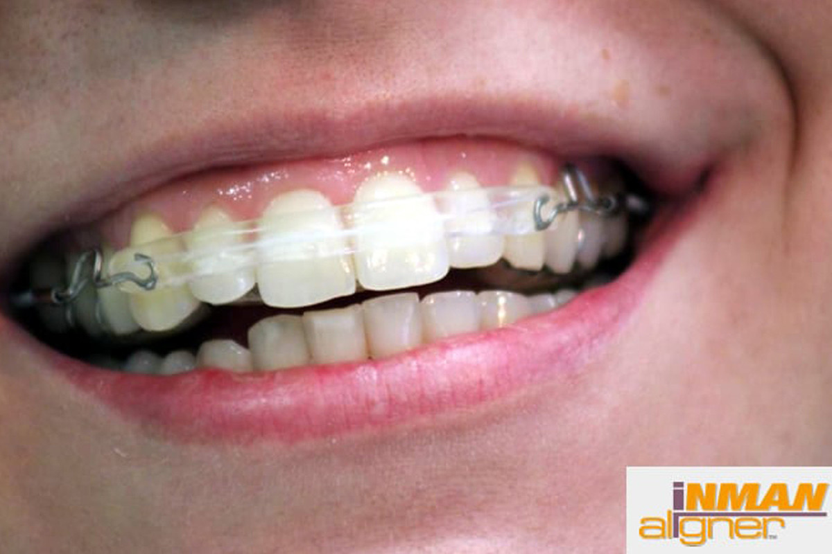 Orthodontc-appliances-service_1/inman-aligner-pacient1